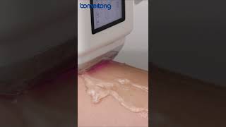 3 Wavelength Diode Laser Hair Removal