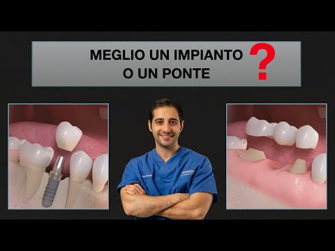 Meglio un ponte o un impianto dentale?