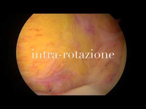 Scattò nel mal di schiena Corsetti per osteocondrosi del collo