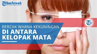 Xanthelasma, Munculnya Bercak Berwarna Kekuningan di Sudut Antara Kelopak Mata dan Puncak Hidung