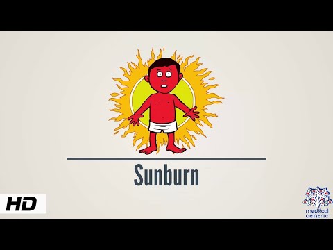 Sunburn Causes Signs and Symptoms Diagnosis and Treatment