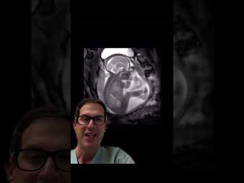 26 weeks gestation? What do #pregnant #moms need to know? #pregnancy #preemie