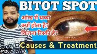 आंख में ये धब्बा कैसा | Bitot Spot Cause & Treatment In Hindi