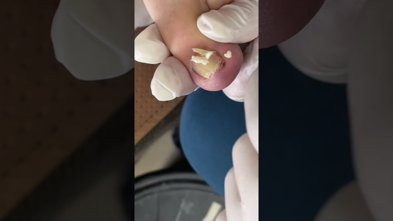 Satisfying Toenail Grooming | Gentle Foot Care Routine  #fypシ #cleannails #RelaxingCare #fypシ