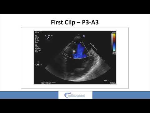 Ultimate mitral repair challenge_Hermiller_Structural On Demand