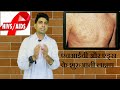 Early Symptoms Of HIV AIDS II एचआईवी और एड्स के शुरुआती �