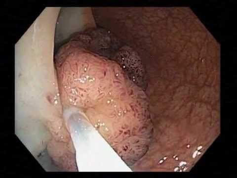 Odbytnica - obraz dużego polipa siedzącego poddanego endoskopowej mukozektomii z klipsową tamponadą krwawienia