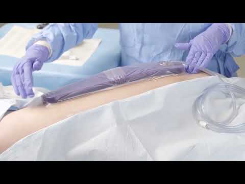 3M™ Prevena™ Plus Peel and Place 35 cm dressing application video