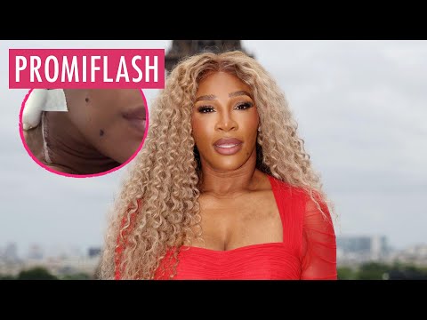 Serena Williams wurde wegen einer Zyste am Hals operiert