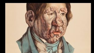 National leprosy programme..