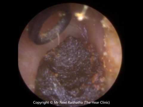 185: Jobson Horne Removal of Ear Wax from Entire Ear Canal - Mr Neel Raithatha (THe Hear Clinic)