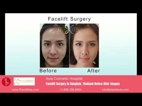 Asia Cosmetic Hospital's Facelift Surgery in Bangkok, Thailand Before and After Visual Narratives