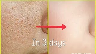 Remove Face holes fast naturally | get clear skin naturally | hole less skin