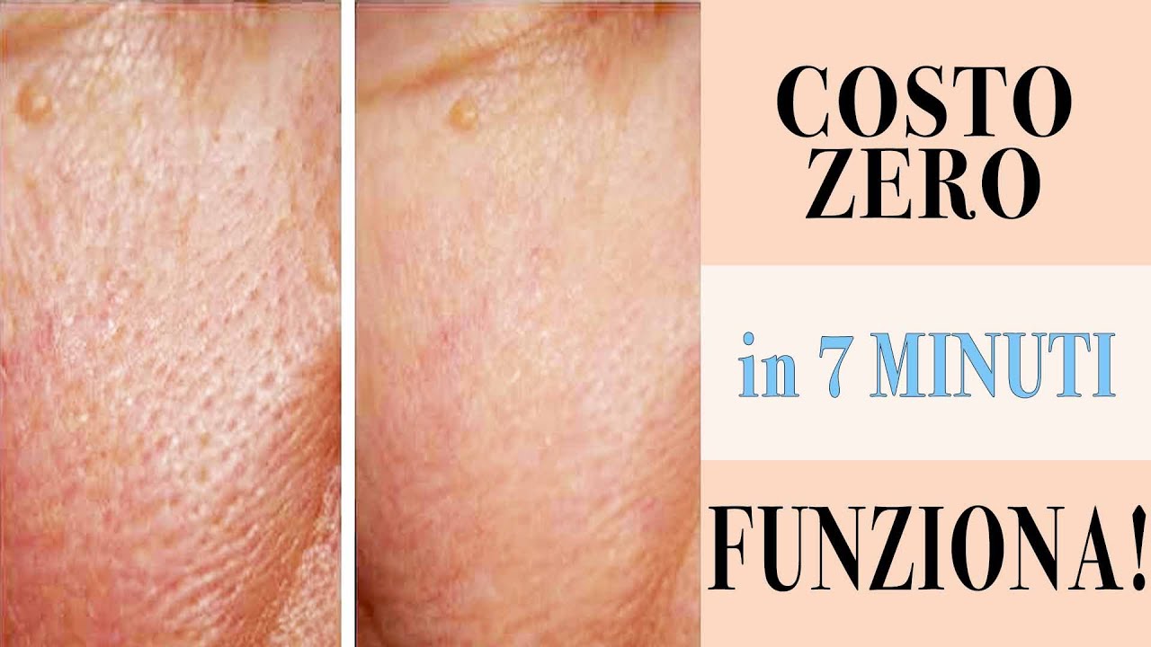 Watch Now ADDIO PORI DILATATI in 7 minuti a COSTO ZERO! FUNZIONA!!! - Heller Gratitude ADDIO PORI DILATATI in 7 minuti a COSTO ZERO! FUNZIONA!!! - Heller Gratitude