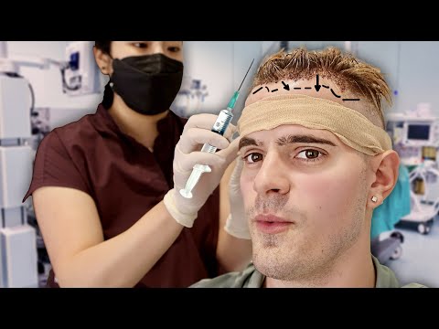 My Hair Transplant Surgery (BEST DECISION EVER)