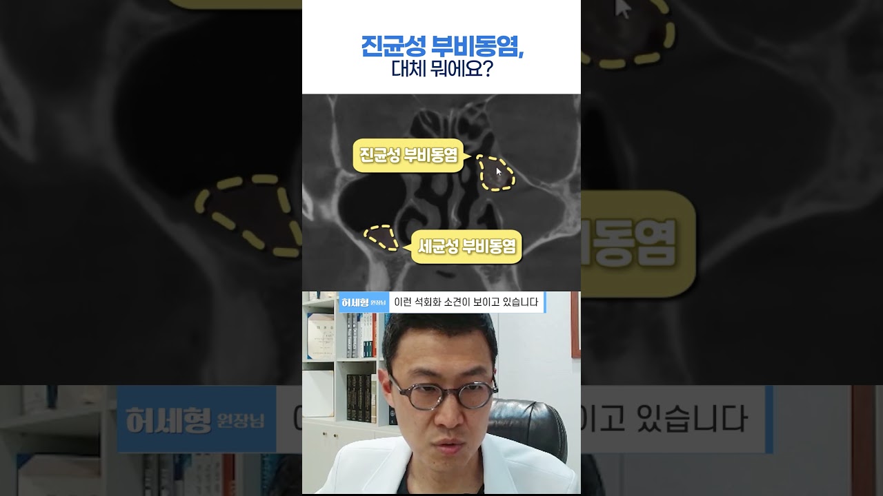 진균성 부비동염, 대체 뭐에요?