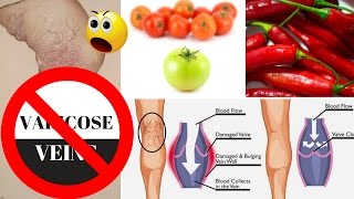 ❤Natural  Home Remedies For Varicose Veins ❤