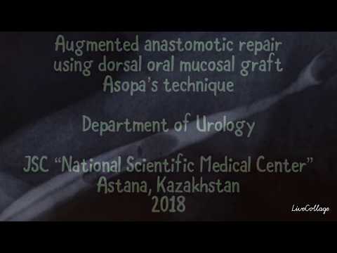 Augmented anastomotic repair using dorsal oral mucosal draft Asopa’s technique
