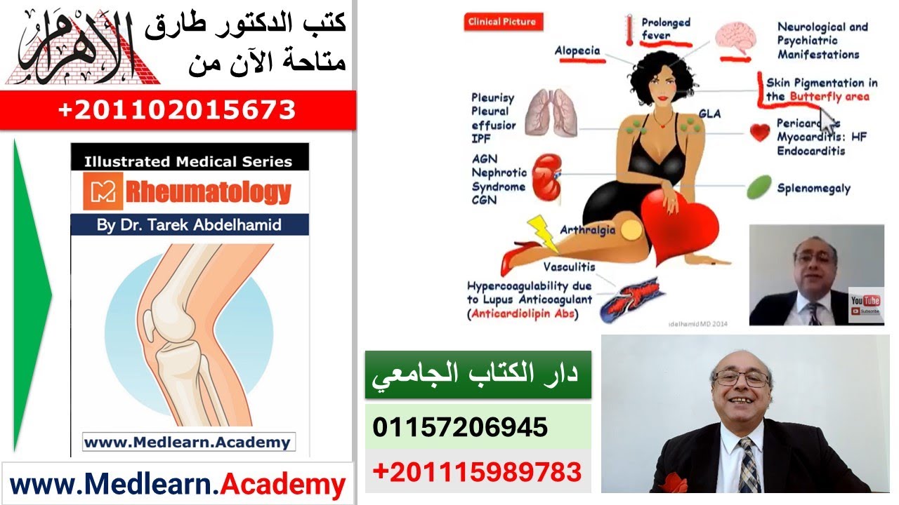 Systemic lupus erythematosus (SLE)   #cme #internal_medicine  #usmle  #medical #محاضرات_باطنة