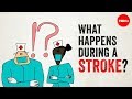 What Happens During A Stroke Vaibhav Goswami