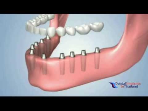 Innovative Treatment Options in Thailand for Missing Teeth.Fixed Bridges Dentures Implants Video