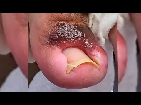 , title : 'INFECTED Overgrown Toenail REMOVAL!!! ***Toe Meat 🥩***'