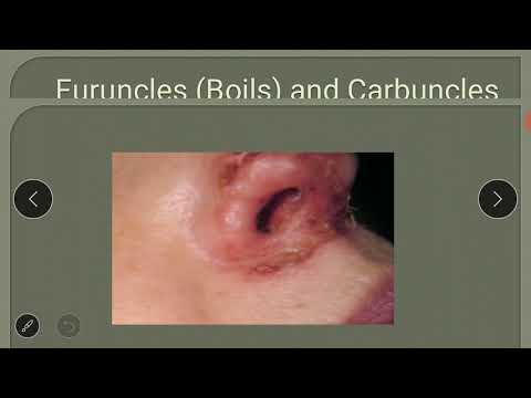 Skin infection & infestation