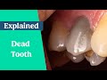 How long can a dead tooth stay in the mouth?