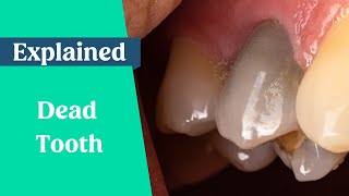 How long can a dead tooth stay in the mouth?