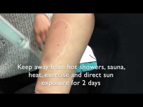 Laser pigmentation removal treatment at Premier Laser & Skin clinic