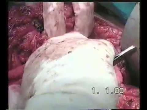 Ilioinguinal Block Dissection For Squamous Cell Carcinoma