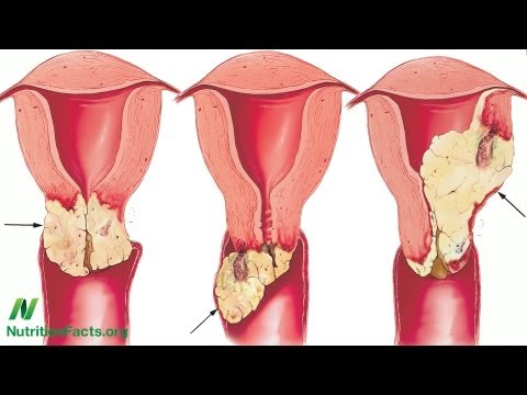 Tünetek | Bél dysbacteriosis - mennyire veszélyes ez?