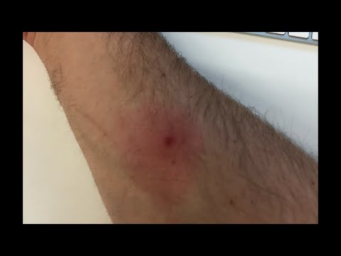 So... I got a spider bite, and things went down hill from there... Thumbnail