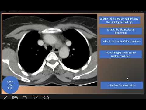 OSCE Case 014 : Superior vena caval duplication