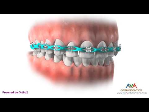 Space Closure by Power Chain - Orthodontic Treatment