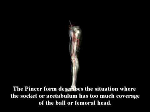 What is FAI? What is Femoral Acetabular Impingement?