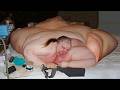 The Sad Life Of The World S Most Obese Person