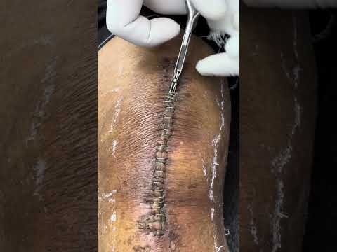 Skin Staple Sutures Removal Technique