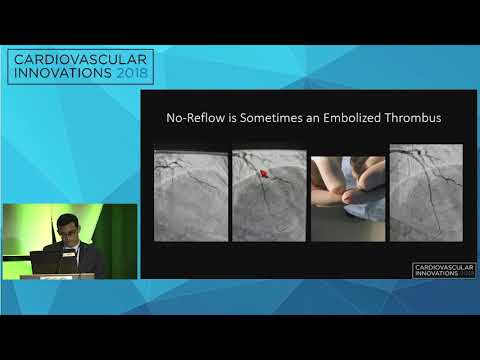 CVI2018 Session: Innovation in coronary thrombus management - Thomas Koshy, MD
