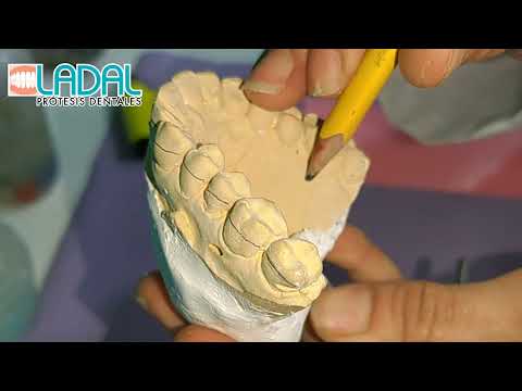 Férula TRANSPARENTE de descarga para pacientes bruxistas