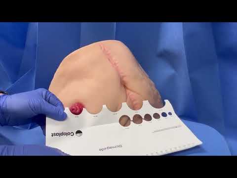 Measuring a stoma and Pouch Positioning