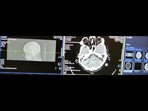 CT Brain Window(Soft tissue window) To differentiate grey matter/white matter pathology