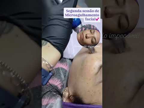 microagulhamento facial  em pauliceia são Bernardo do campo são paulo
