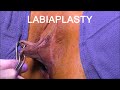 Labiaplasty and Clitoral Hood Contouring for Dark, Long Skin