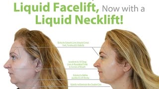 The New & Improved Liquid Facelift, Now with A Necklift