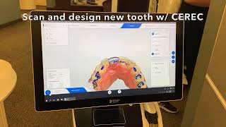 Every week I am asked, “How quickly can I replace my dead tooth with a ceramic implant?”