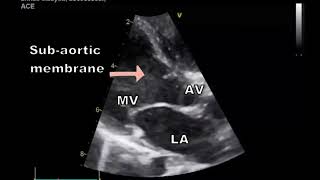 Tips and tricks of VSD echocardiography (Ventricular Septal Defect)