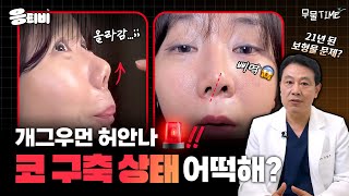 [무.물] 개그우먼 허안나 코 구축 상태 어떡해❓｜1%성형외과  #김종구 #코수술 #코재수술