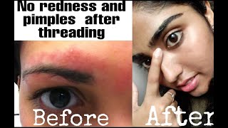 How you can remove redness and pimples after threading