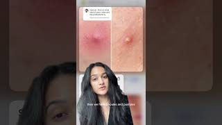 Download lagu 3 main types of acne and how to treat them mp3